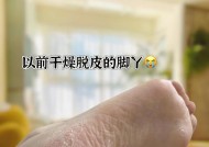 女人脚后跟硬皮怎么办（健康的方法让你告别脚后跟硬皮）