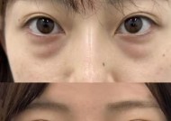 寻仙通天河去眼袋的方法是什么？去眼袋后效果如何？