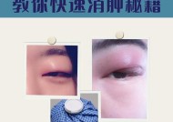 早上怎么快速消肿（15个小技巧帮你迅速消除眼睛浮肿）