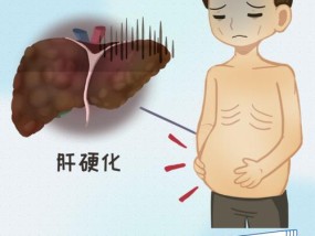 肝硬化早期症状，及时发现关键（三大症状揭示肝硬化的早期预警信号）
