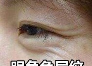 如何有效去除眼角鱼尾纹（护眼肌）