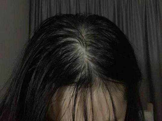 女人头发掉得厉害该怎么办（解决女性脱发的7个方法）  第3张