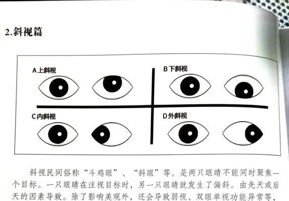 从生活习惯到遗传基因，看看斜视的真正原因（从生活习惯到遗传基因）  第3张