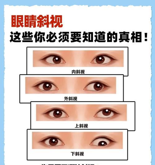 从生活习惯到遗传基因，看看斜视的真正原因（从生活习惯到遗传基因）  第2张