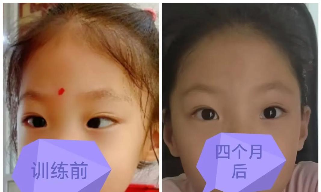 从生活习惯到遗传基因，看看斜视的真正原因（从生活习惯到遗传基因）  第1张