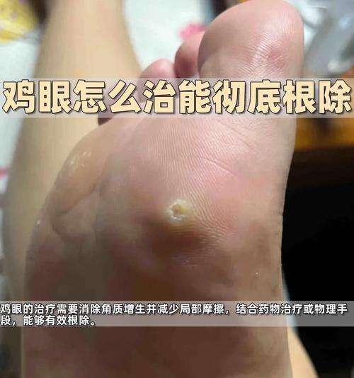 解决脚上鸡眼问题的实用方法（告别疼痛与不适）  第2张