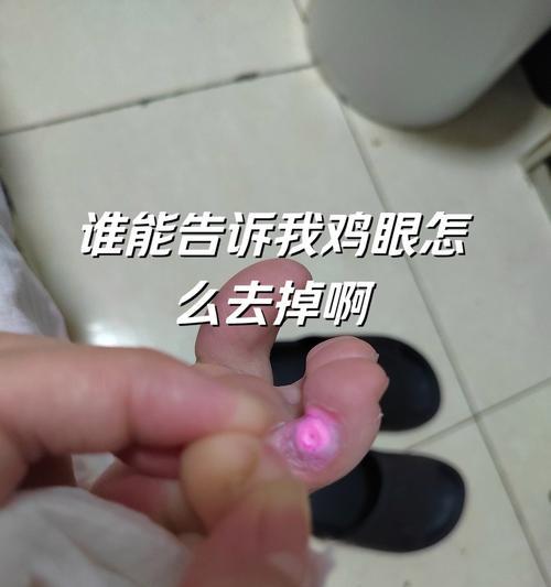 解决脚上鸡眼问题的实用方法（告别疼痛与不适）  第3张
