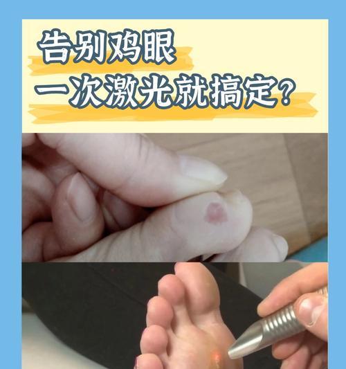 解决脚上鸡眼问题的实用方法（告别疼痛与不适）  第1张