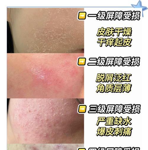 冬天护肤全攻略（告别干燥肌）  第3张