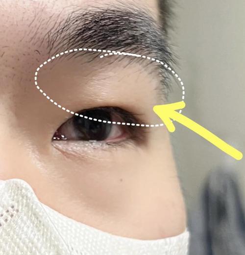 早上怎么快速消肿（15个小技巧帮你迅速消除眼睛浮肿）  第2张