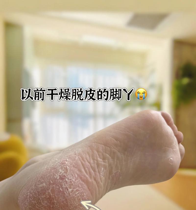 女人脚后跟硬皮怎么办（健康的方法让你告别脚后跟硬皮）  第1张