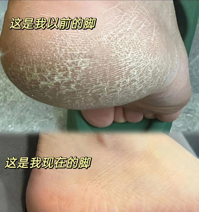 女人脚后跟硬皮怎么办（健康的方法让你告别脚后跟硬皮）  第3张