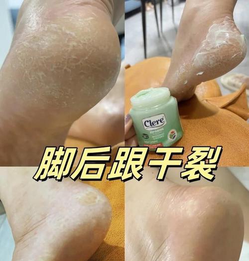女人脚后跟硬皮怎么办（健康的方法让你告别脚后跟硬皮）  第2张